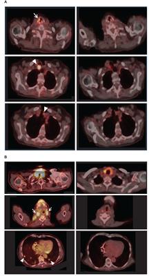 Improving the response to lenvatinib in partial responders using a Constrained-Disorder-Principle-based second-generation artificial intelligence-therapeutic regimen: a proof-of-concept open-labeled clinical trial